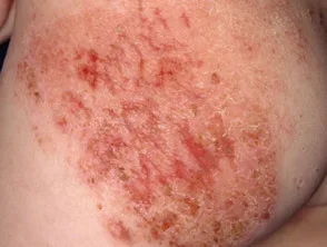 Atopische dermatitis