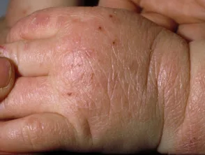 Atopische dermatitis