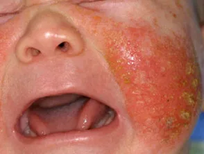 Atopische dermatitis