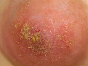 Atopische dermatitis