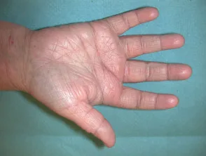 Atopische dermatitis