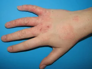 Atopische dermatitis