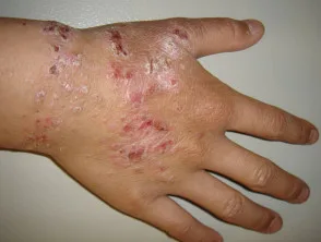 Atopische dermatitis