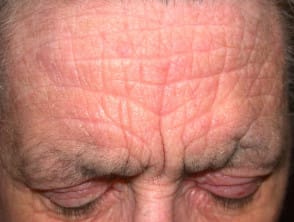 Atopische dermatitis