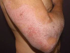 Atopische dermatitis