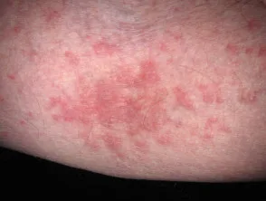 Atopische dermatitis