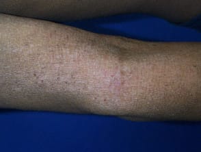 Atopische Dermatitis