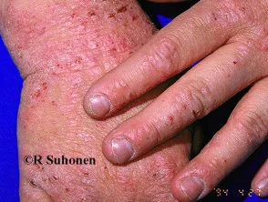 Atopische dermatitis