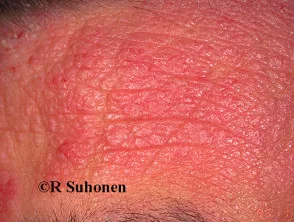 Atopische dermatitis