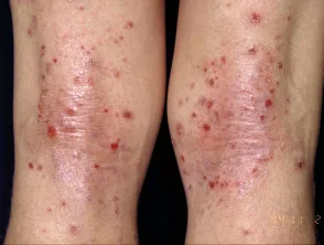 Atopische dermatitis