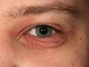 Blefaritis asociada a dermatitis atópica