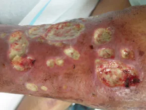 Mycobacterium chelonae