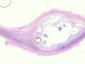 Pathologie der Pseudozyste der Ohrmuschel