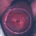 balanitis-s__protectwyjqcm90zwn0il0_focusfillwzi5ncwymjisingildfd-1013572-4314034-jpg-7428593
