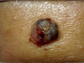 Carcinoma basocelular en piel de color