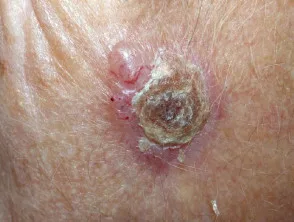 Carcinoma spinocellulare