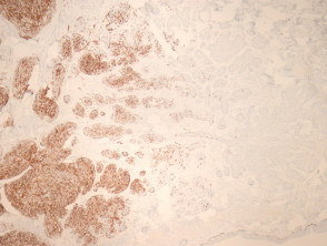 Patologia del tumore basomelanocitico maligno