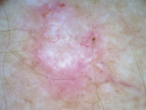 Dermatoscopia por carcinoma nodular de células basales no pigmentado 