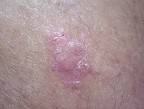 Carcinoma a cellule basali nodulari