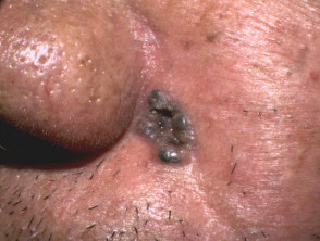 Carcinoma nodular de células basales