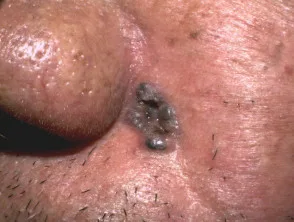 Carcinoma a cellule basali nodulari