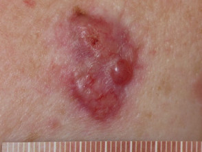 Carcinoma nodular de células basales