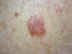 Carcinoma a cellule basali nodulari