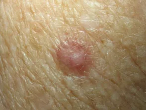 Carcinoma delle cellule basali