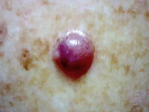 Carcinoma a cellule basali nodulari