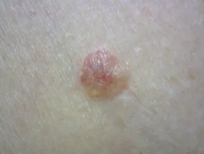 Carcinoma a cellule basali nodulari