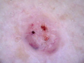 Dermatoscopia de carcinoma basocelular nodular