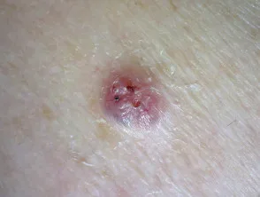 Carcinoma a cellule basali nodulari