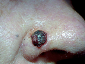 Carcinoma de células basales pigmentado