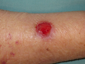 Carcinoma de células basales, brazo