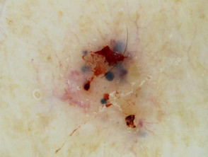Nidos ovoides azul grisáceos en dermatoscopia de carcinoma de células basales pigmentado