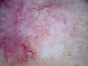 Dermatoscopia de carcinoma de células basales