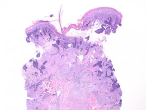 Pathologie des Basalzellkarzinoms