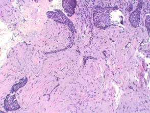 Pathologie des Basalzellkarzinoms