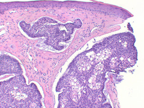 Patología del carcinoma de células basales