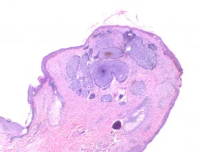 Pathologie des Basalzellkarzinoms