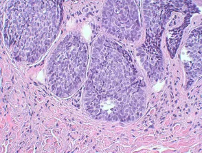 Pathologie des Basalzellkarzinoms