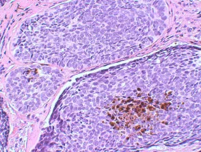 Pathologie des Basalzellkarzinoms