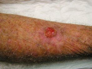 Carcinoma de células basales, pierna