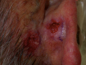 Carcinoma de células basales ulcerado