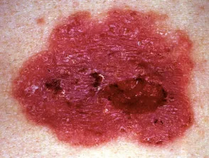 Carcinoma delle cellule basali