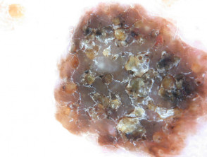 Dermatoscopia de queratosis seborreica