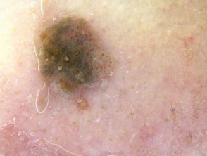 Dermatoscopia de queratosis seborreica