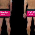 before-and-after-secukinumab__protectwyjqcm90zwn0il0_focusfillwzi5ncwymjisingildqxxq-4970643-5200532-png-1886565