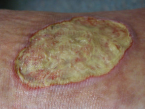 Úlcera crónica