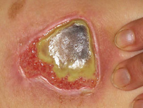 Úlcera crónica